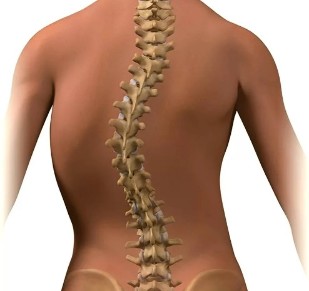 Scoliosis