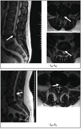 MRI of a herniated disc in the spine