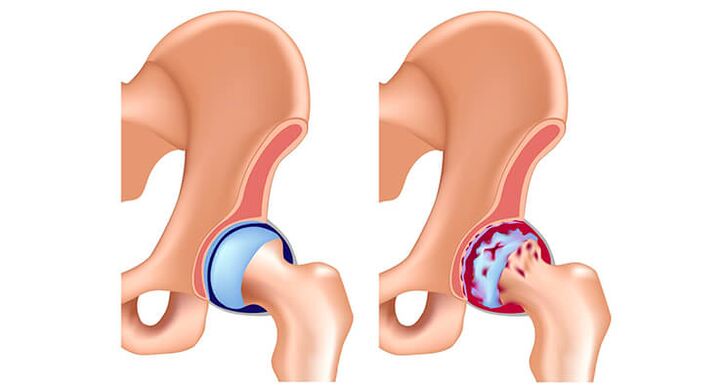 healthy and osteoarthritic hip joint